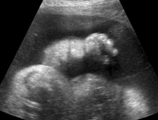 Obrzęk przedramienia u płodu wraz ze skróceniem kości przedramienia. Rycina 5. Dysplazja tanatoforyczna w prenatalnym badaniu USG.