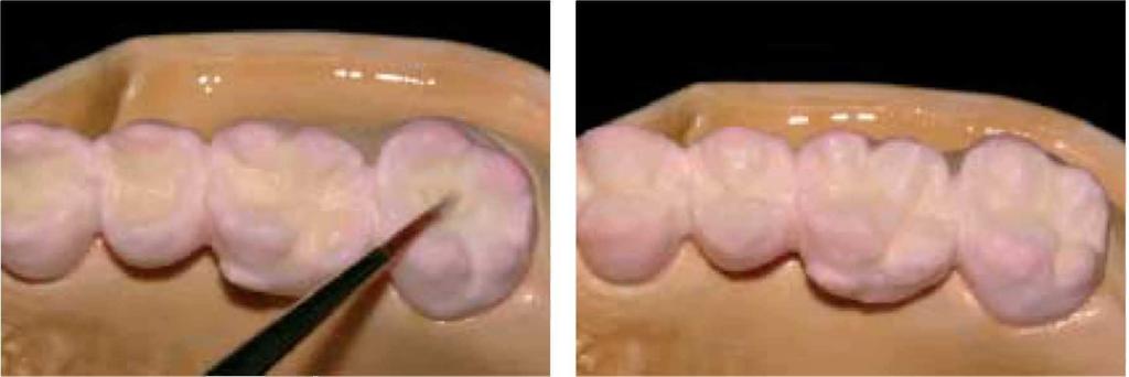 Nałóż Occlusal Dentin orange i wykończ powierzchnię