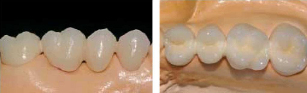 Wygląd pracy po napaleniu pierwszej warstwy dentyny i brzegu siecznego Parametry napalania dla pierwszej Dentin/Incisal (kontroluj temperaturę) Wypalanie korekcyjne dentyny i