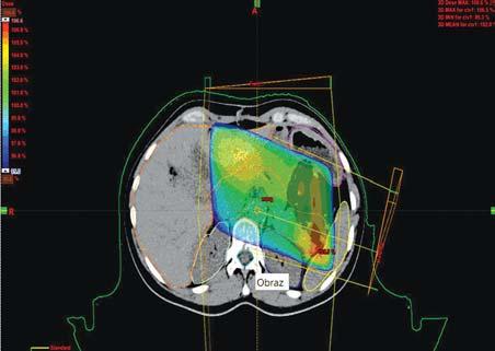 radioterapii konformalnej (3D-CRT), realizowanej w oparciu o trójwymiarowe obrazy tomografii komputerowej (CT) z możliwością fuzji z obrazami rezonansu magnetycznego (NMR) lub pozytronowej tomografii