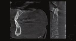 pojedynczych implantów Ekstrakcja zębów mądrości Zęby