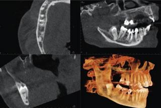 skanowania/naświetlania9 s Wysokość pola obrazu 147 mm Programy obrazowe Standardowy, Segmentacja, Pediatryczny, Stawy skroniowo-żuchwowe, zdjęcia skrzydłowo-zgryzowe 3D/CBCT Detektor obrazu CMOS