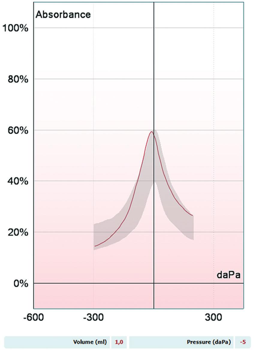 się krzywe tympanometryczne z zakresu 800 2000 Hz, a dla dzieci starszych i dorosłych zakres ten wynosi 375 2000 Hz [13] (Rycina 2). KRZYWA ABSORBCJI W badaniu ucha absorbcja (ang.