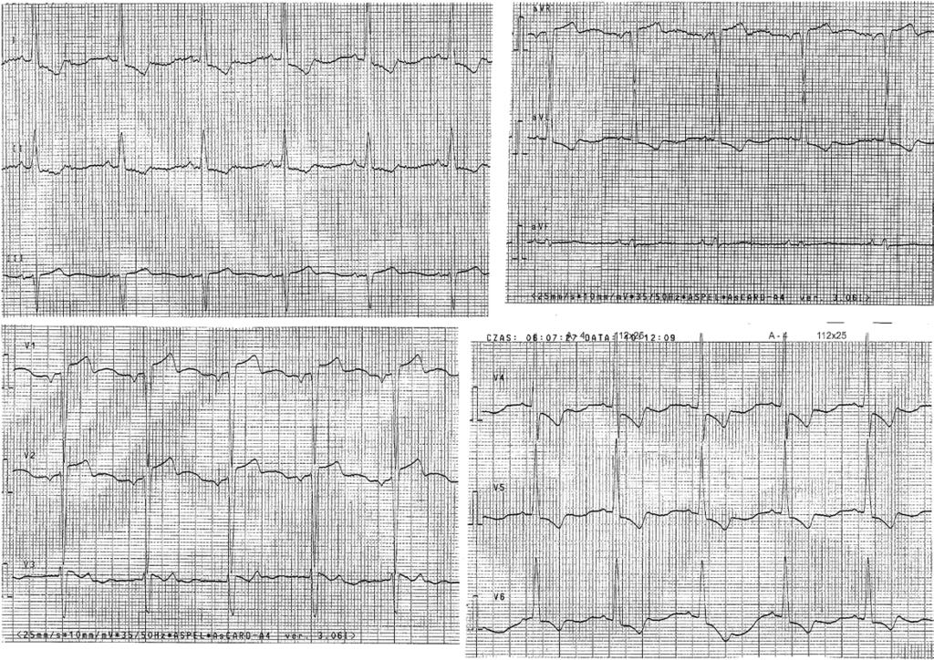 Spełnione kryteria amplitudowe LVH: RV5/6 > 26 mm, SV1 + RV5/6 > 35 mm. Brak innych zmian sugerujących LVH. Rycina 4.