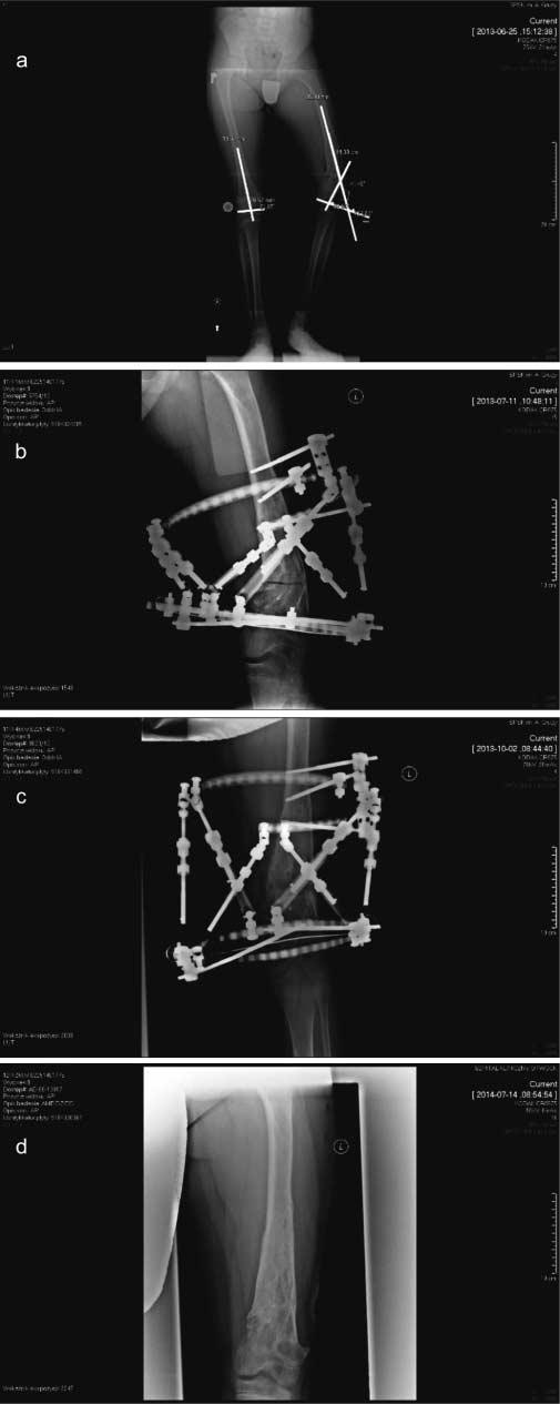 Zniekształcenia kończyn dolnych w przebiegu choroby Olliera wydłużanie i korekcja osi z zastosowaniem stabilizatorów zewnętrznych zosiowanie segmentów kończyny dolnej).
