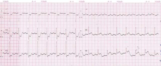 ECG