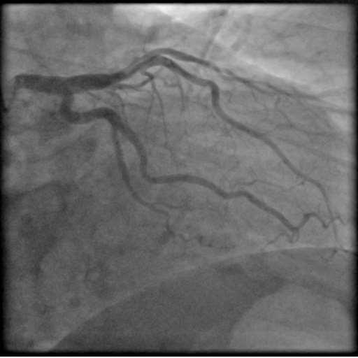 Coronary angiography