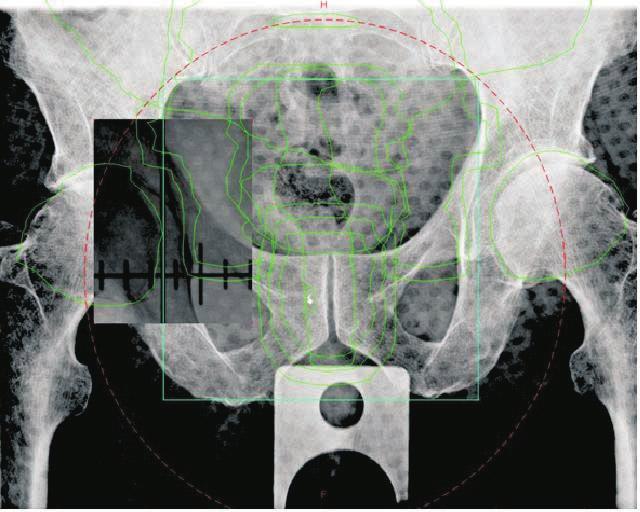 ZASTOSOWANIE Z OTYCH ZNACZNIKÓW W RADIOTERAPII KIEROWANEJ OBRAZEM U CHORYCH NA RAKA GRUCZO U KROKOWEGO Zastosowanie systemu 2D-2D KV bez wczeœniejszej implantacji znacznika pozwala³o dotychczas