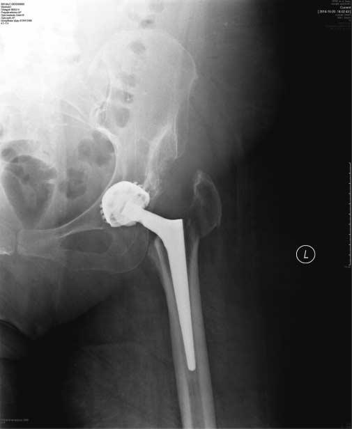 3d. Chora A.P. Złamanie zaopatrzono pętlami metalowymi. Widoczny zrost kostny w miejscu złamania.