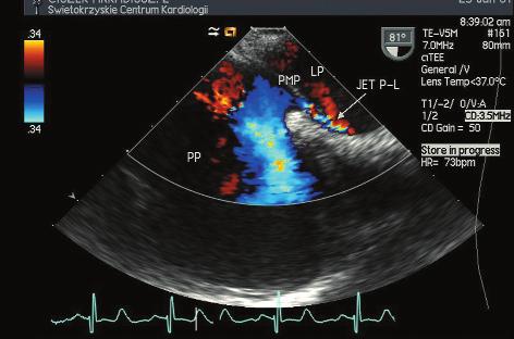 324 Beata Wożakowska-Kapłon, Ewa Maroszyńska-Dmoch Rycina 3. Badanie echokardiograficzne przezprzełykowe podłużna wysoka.