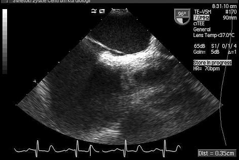 Pomiar szerokości kanału przetrwałego otworu owalnego, odległość między przegrodą pierwotną i wtórną wynosi 3,5 mm Rycina 4. Badanie echokardiograficzne przezprzełykowe podłużna wysoka.
