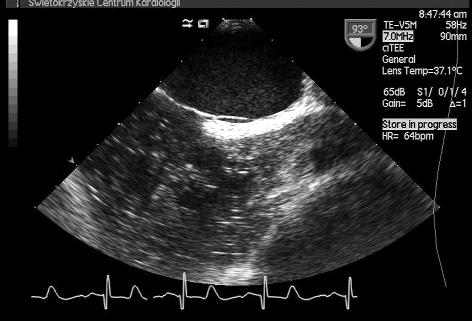 Uznano PFO za istotny hemodynamicznie i stanowiący potencjalny czynnik ryzyka udaru niedokrwiennego mózgu w mechanizmie zatorowości paradoksalnej.