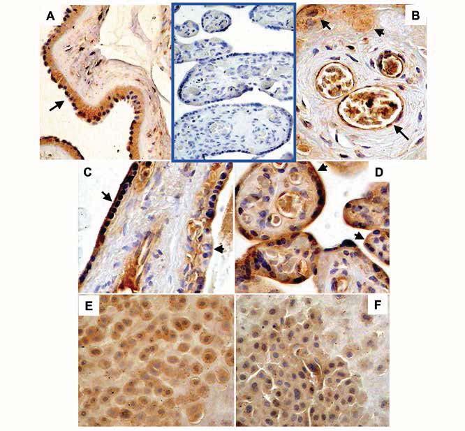 P R A C E O R Y G I N A L N E Figure 1. P-gp immunolocalization in normal and GDM human placentas at term. Microphotographs show P-gp detection in human placenta.