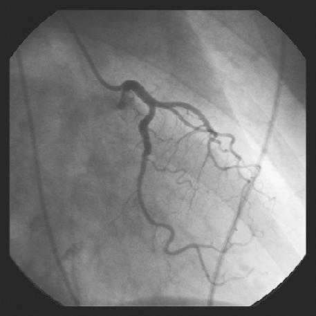 218 Łukasz Pastwa et al Rycina 2. Angiogram prawidłowej lewej tętnicy wieńcowej omawianej chorej Rycina 3. Angiogram prawej tętnicy wieńcowej uzyskany na początku koronarografii.