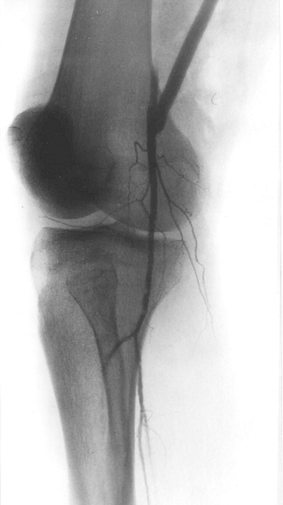 The proximal anastomosis of the femoro-popliteal bypass graft in patient with ischemic diabetic foot Rycina 3. Arteriografia pooperacyjna.