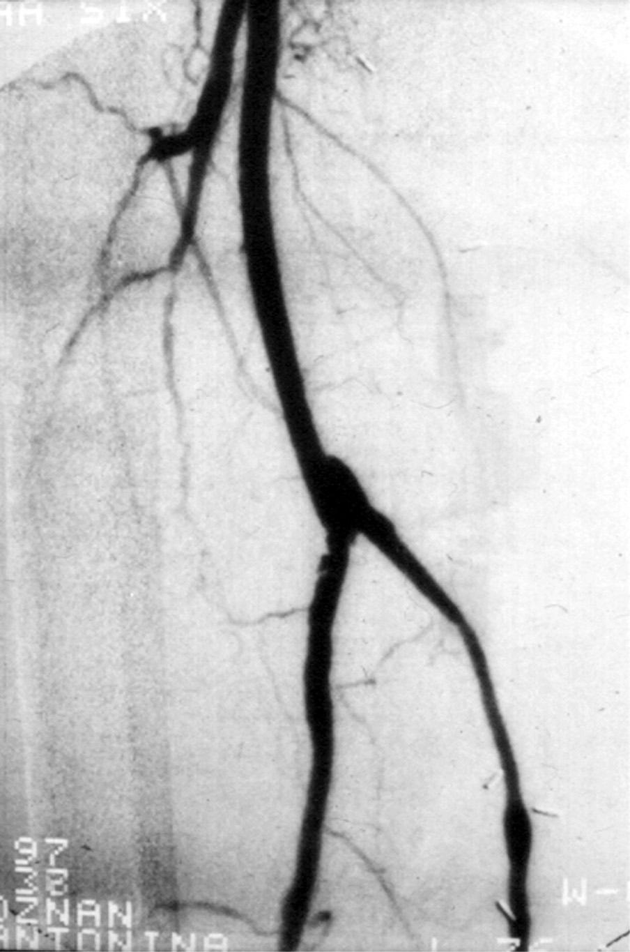 The distal anastomosis of the femoro-popliteal bypass graft with proximal segment of popliteal artery in patient with ischemic diabetic foot Rycina 2. Arteriografia śródoperacyjna.