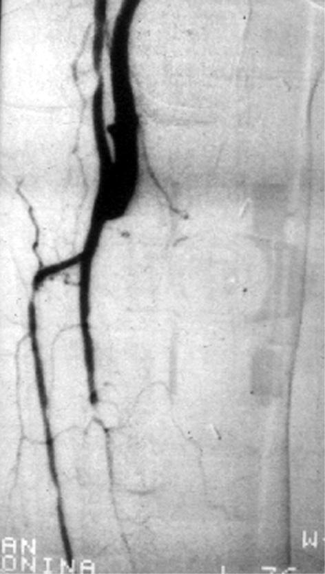 Revascularisation in diabetic foot, Dzieciuchowicz et al. A B C D Figure 4. AB.