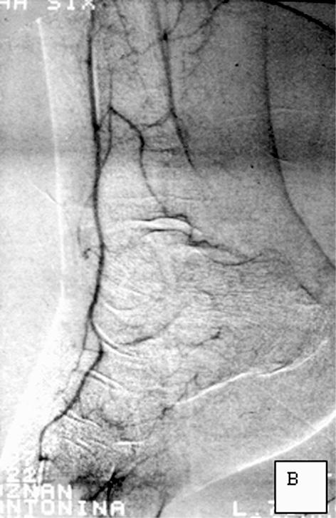 Good clinical effect in a patient following femoro-popliteal bypass: necrotic heel ulcer; D. Healed four weeks after implantation of the bypass Rycina 4. AB.