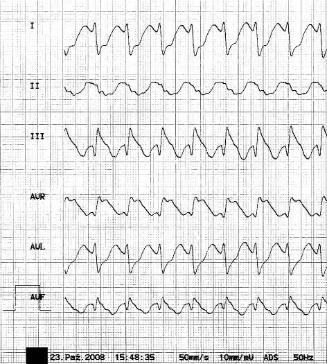 Następna elektrowersja czy ablacja RF podłoża typowego trzepotania przedsionków u zawodowego kierowcy z napadami MAS 333 sionkowo-komorowego (p-k).