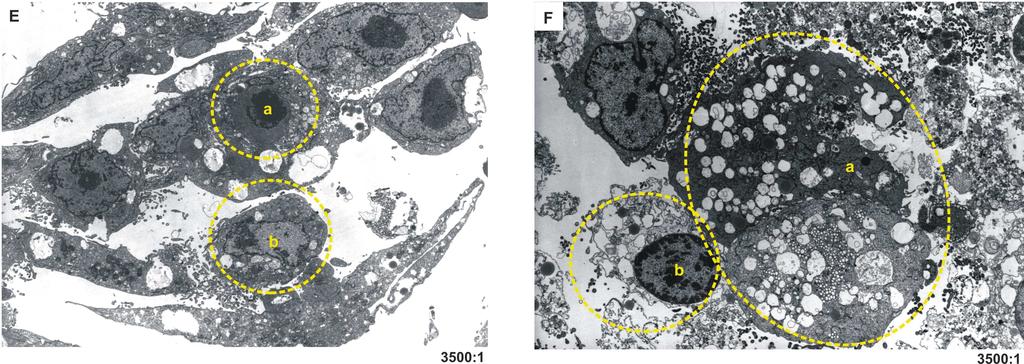 Ryc. 18 E, F. Mikrofotografie komórek JAR poddanych działaniu 100 µm wodoronadtlenku tert-butylu: E komórki po 4 godzinach inkubacji z tbuooh, a. komórka apoptotyczna, b.
