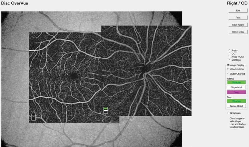 Ograniczenia angio-oct są takie jak standardowej optycznej koherentnej tomografii: oczopląs, brak możliwości zbadania obwodu siatkówki.