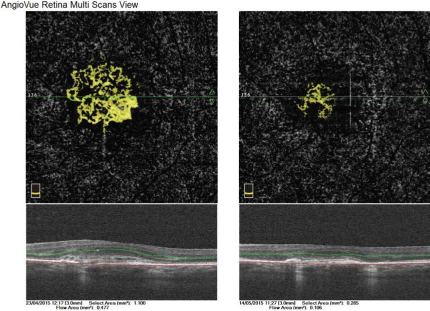 RYCINA 9 Angio-OCT, analiza seryjna, widoczne zmniejszenie powierzchni patologicznego przepływu w błonie CNV w kolejnym badaniu (po prawej).