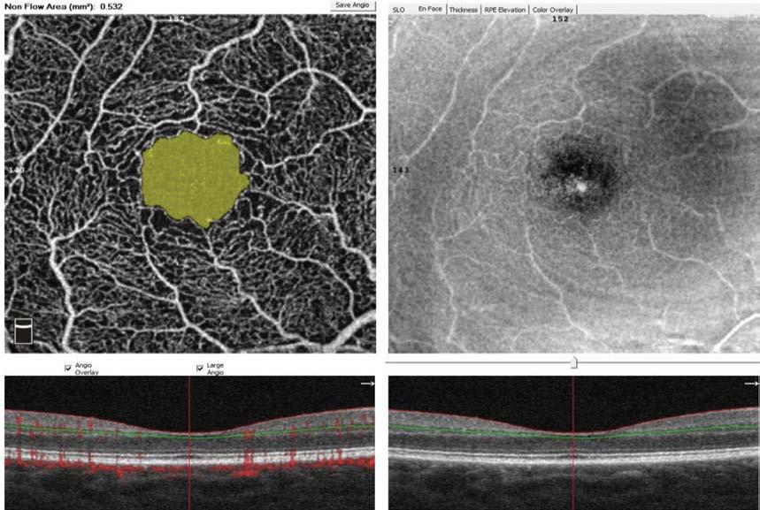 w niewidocznym w AF splocie głębokim. W zmianach wczesnych w przypadku okluzji małych naczyń widoczne są obszary niedokrwienia w tylnym biegunie, a sieć kapilar staje się wyraźnie luźniejsza.
