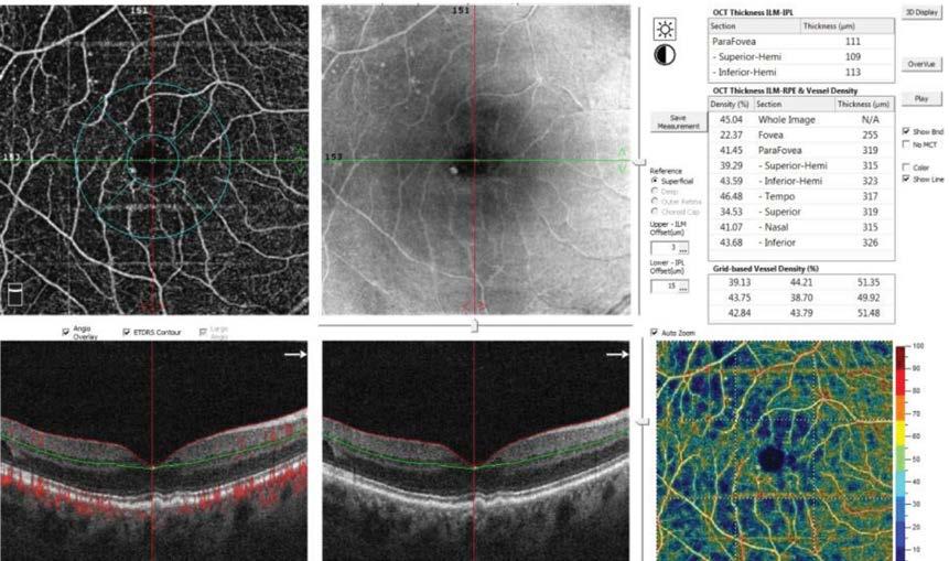 Nowoczesne opcje analizy zastosowane w angio-oct pozwalają na obiektywny pomiar FAZ (opcja non flow) i gęstości przepływu w plamce (opcja density).