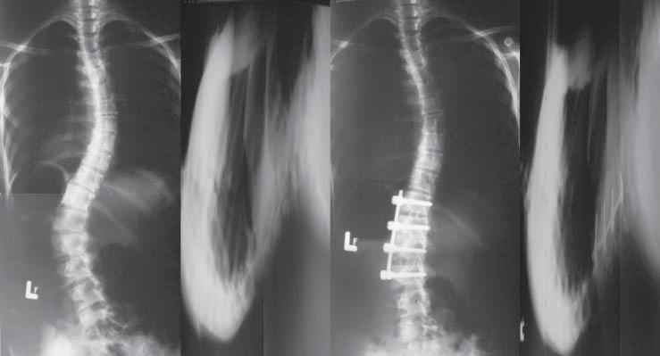 Sagittal spinal balance after anterior fusion in lumbar scoliosis was the smallest at the beginning (11.4 o ) and increased after surgery to 17.7 o and 17.3 o after follow up period (fig.1).