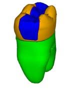 trzonowy żuchwy odbudowany ceramicznym wkładem MOD. T a b e l a I.
