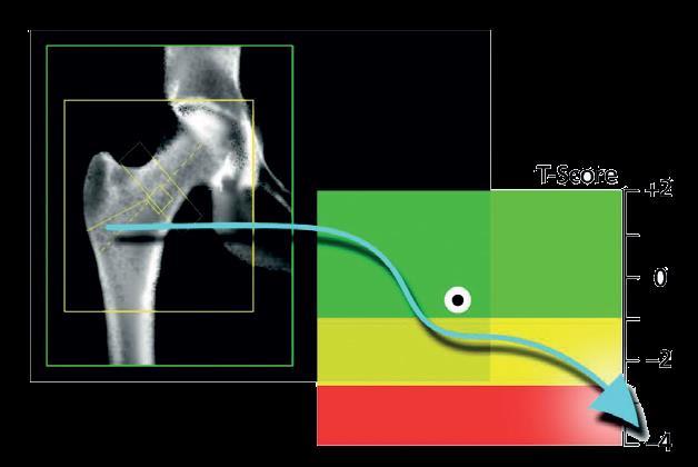Wynik badania wyrażony jest za pomocą wskaźników porównujących gęstość kości osoby badanej z gęstością kości młodych zdrowych osób (T-score) i rówieśników (Z-score).