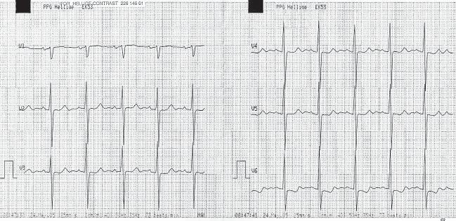 QT = 440 ms, QTc = 611 ms wydłużony odstęp QTc cych chorób należała cukrzyca (DM, diabetes mellitus) występująca u 38 pacjentów (38%) oraz nadciśnienie