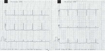 Anna Tomaszuk-Kazberuk i wsp., Rokowanie a EKG u chorych dializowanych Rycina 3. Rytm zatokowy o częstości 83/min, oś pośrednia, cechy przerostu i przeciążenia lewej komory.