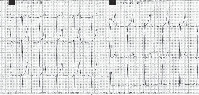 QT = 420 ms, QTc = 438 ms Tabela 1.