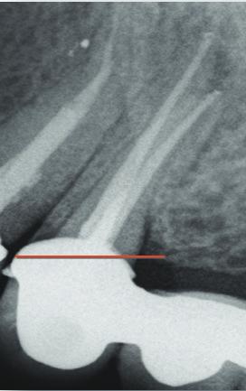 jego zakrzywienie. System endodontyczny 1-kanałowy.