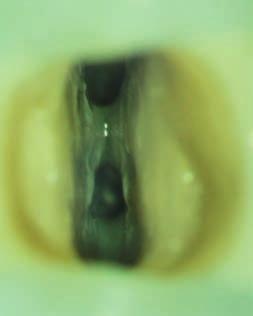 system endodontyczny 3-kanałowy przy obecności 2 korzeni utrudnia leczenie endodontyczne ze względu na bliskie położenie
