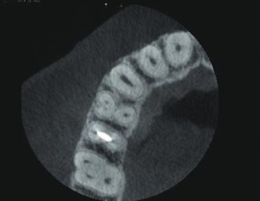 ENDODONCJA MIKROSKOPOWA. ATLAS system endodontyczny 3-kanałowy przy obecności 3 korzeni grozi całkowitym niepowodzeniem leczenia endodontycznego w przypadku nierozpoznania tej anomalii.