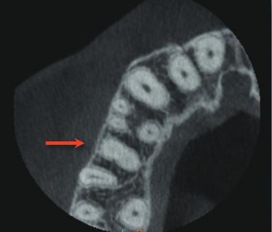 D:15 powtórne leczenie endodontyczne, dolegliwości bólowe, obliteracja kanałów w części środkowej, ząb 2-kanałowy: na RVG własnym pacjenta widoczne było światło kanału głównego wypełnione jedynie do