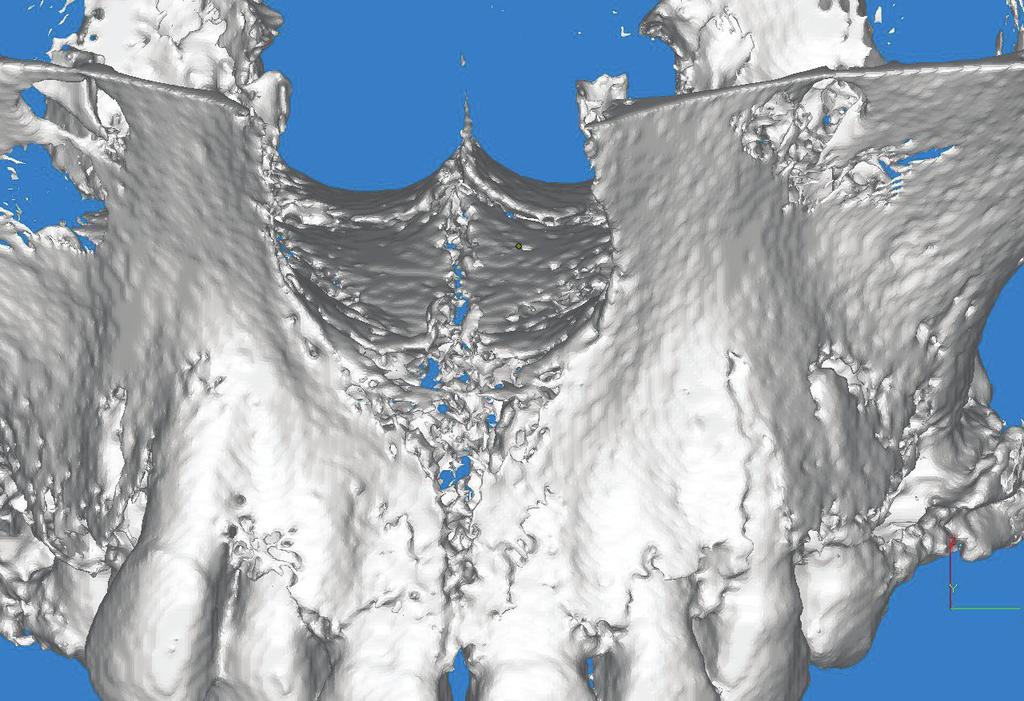 tio np roh ibit ed. Strzecki A., Miechowicz S., Pawłowska E. Fig. 7. 3D digital model of patient s maxilla after completion of the active phase of RME (T2) anterior view.