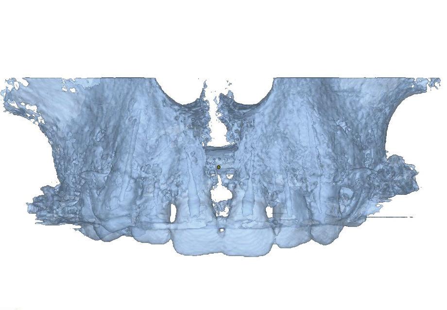 3D digital model of patient s maxilla prior to the onset of treatment (T1) the area of palatal raphe anterior view.