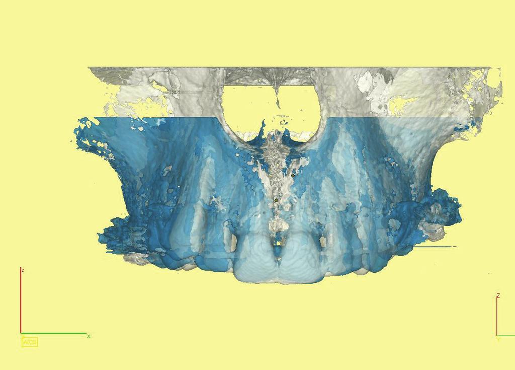 tio np roh ibit ed. J Stoma 2014; 67, 1 Fig. 11. Superimposed T1 (white) and T2 (blue) 3D digital models of patient s maxilla. View from above.
