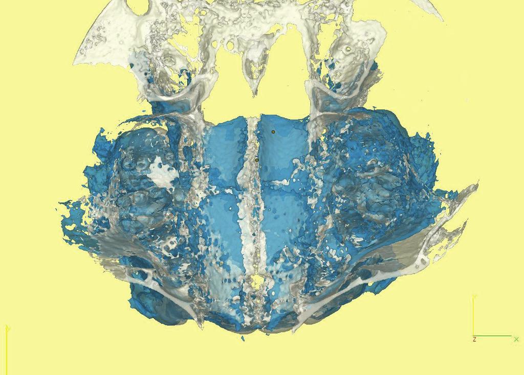 Superimposed T1 (white) and T2 (blue) 3D digital models of patient s maxilla. Anterior view. Nałożone na siebie modele 3D z etapów T1 (biały) oraz T2 (niebieski) widok z przodu.