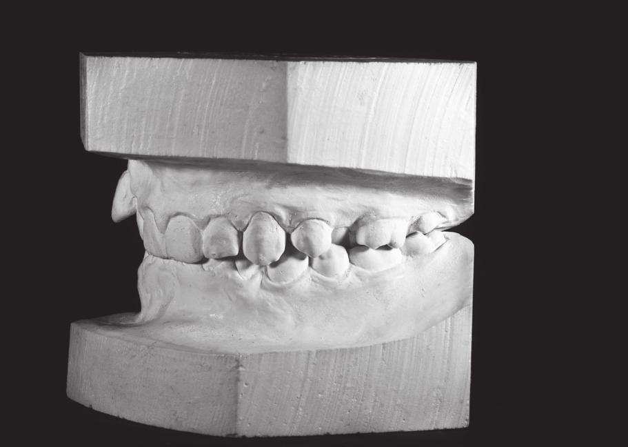 Trójwymiarowy model szczęki pacjenta przed rozpoczęciem terapii (T1) widok od strony podniebienia. Czerwonymi prostokątami zaznaczono nieprawidłowości zębowe.