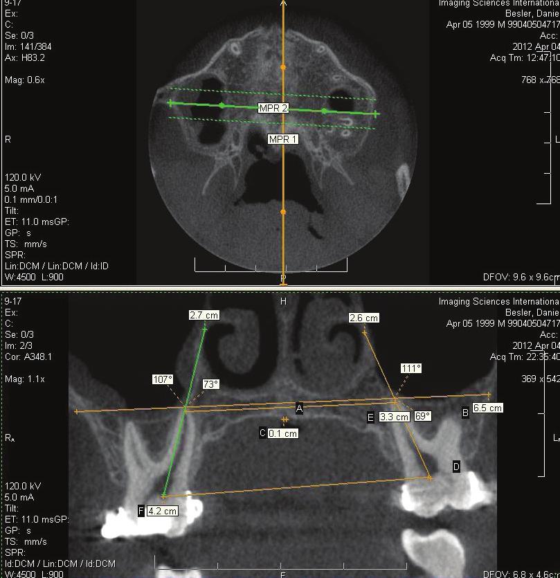a 1st molar buccal angulation values measured prior to the onset of treatment (T1); b 1st molar buccal angulation values measured after completion of the active phase of RME (T2).
