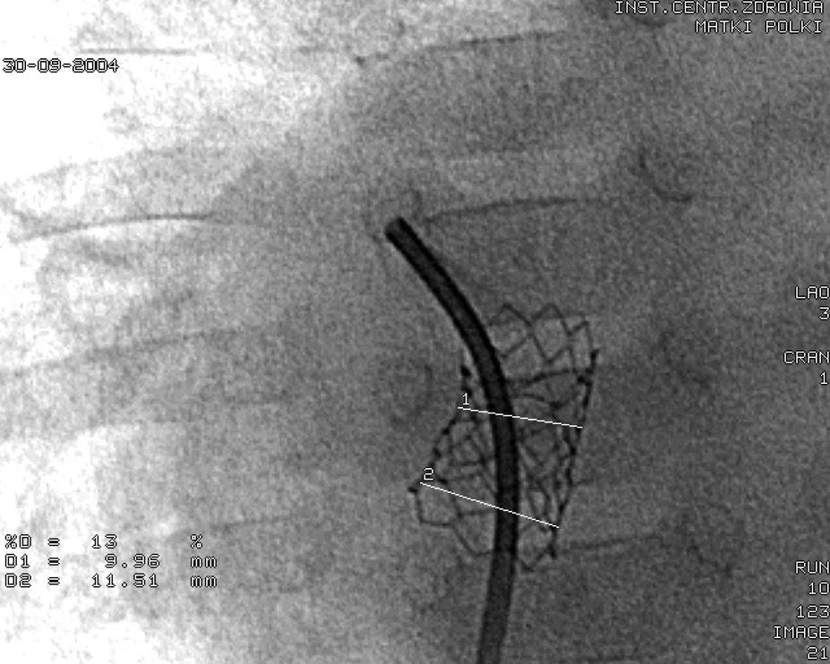 Figure 3. Case 2: Balloon calibration of the atrial septal defect diameter left oblique angiographic view (arrow show the stretch diameter) Figure 5.