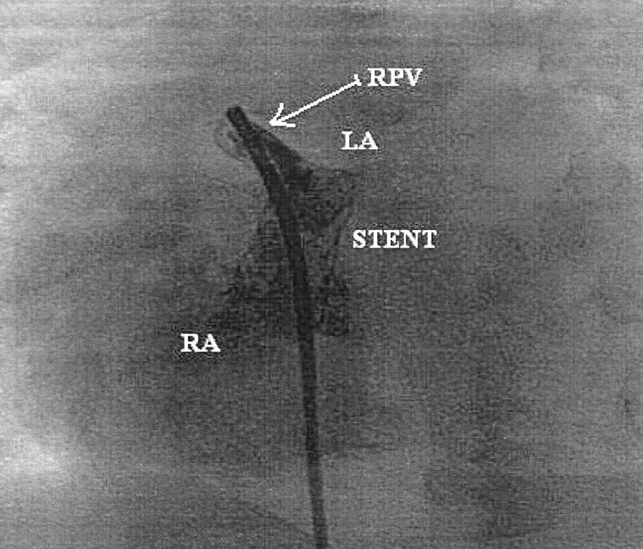 echokardiografii przezprzełykowej i skopii rentgenowskiej) wprowadzono stent PALMAZ LARGE 10 18 mm, dokonując jego implantacji w miejsce ubytku międzyprzedsionkowego (ryc. 4, 5).