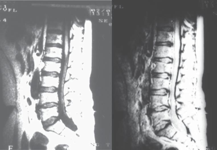 MR image of the intervertebral disc following discectomy 29 Tab. 3. MRI 12 weeks post surgery Lowering of the signal from the intervertebral disc 46 patients (90.