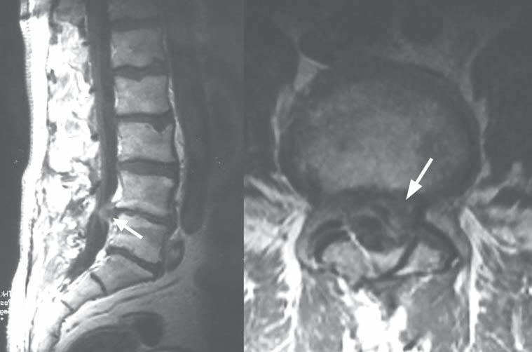 3%) Presence of oedematous lesions on surfaces 10 patients of the vertebral body adjacent to the operated disc (19.6%) (in all cases, the lesions were smaller compared to MRI 6 weeks before) Tab. 3.