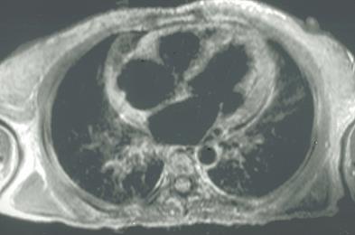 rozróżnia struktury anatomiczne na obrazach T1- i T2-zależnych. Przykładowe zadanie 4. Na skanie rezonansu magnetycznego serca, strzałką oznaczono A. przedsionek prawy. B. przedsionek lewy. C.