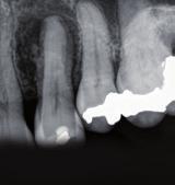 W związku z martwą miazgą doszło do rozwoju widocznej na obrazie radiograficznym zmiany pochodzenia endodontycznego.